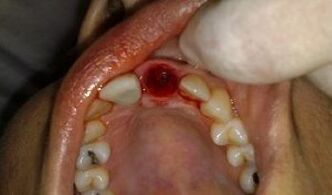 place of extracted teeth